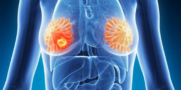 Medical illustration showing a transparent view of a female torso with highlighted breast tissue and a visible tumour in the left breast, indicating breast cancer.
