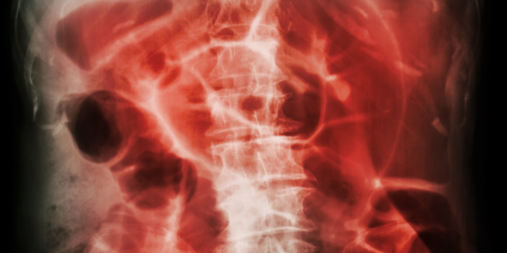 X-ray image of a human abdomen and lower spine area, shown in red tones, highlighting the bones and gas patterns within the intestines.