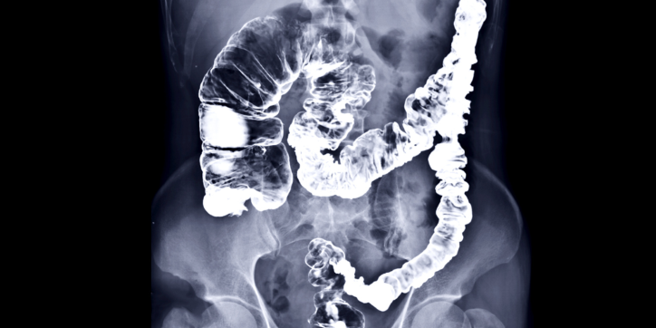 X-ray image of a human abdomen showing the colon highlighted with contrast, revealing the structure and outline of the large intestine.