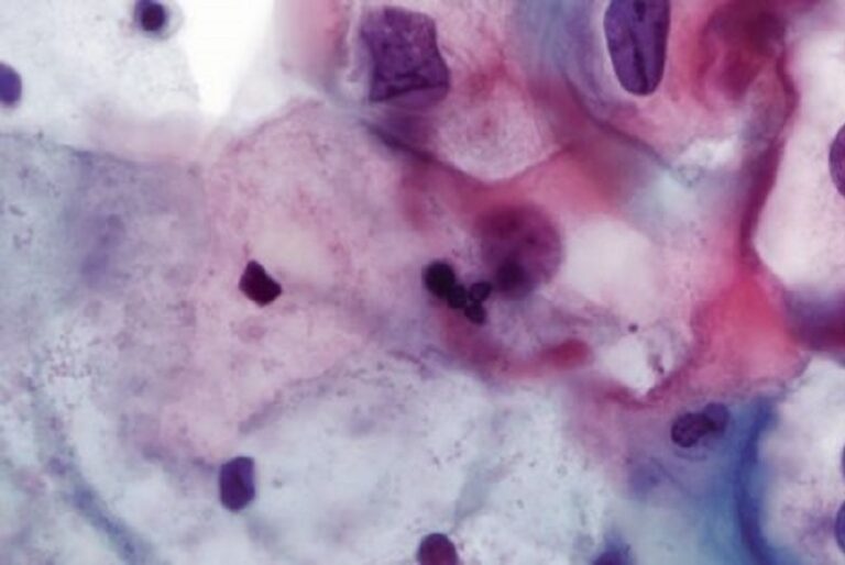 Microscopic view of human cells stained in purple and pink, showing irregular shapes and clusters against a blurred background.