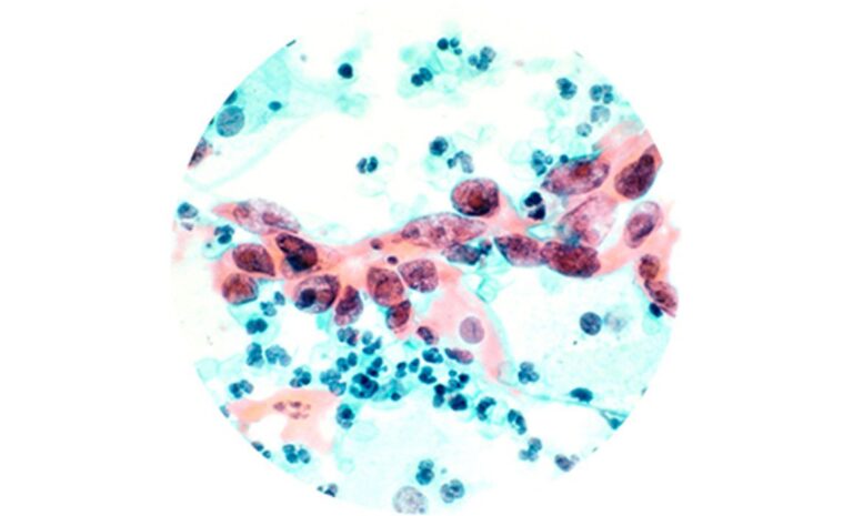 Microscopic image showing clusters of blue and pink stained cells. The cells vary in size and shape, with some clustered and others scattered, all viewed through a circular field of view.