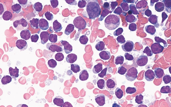 Microscopic image of blood cells showing many large, round purple cells mixed with smaller pink cells, indicating possible abnormal cell activity or a haematological disorder.