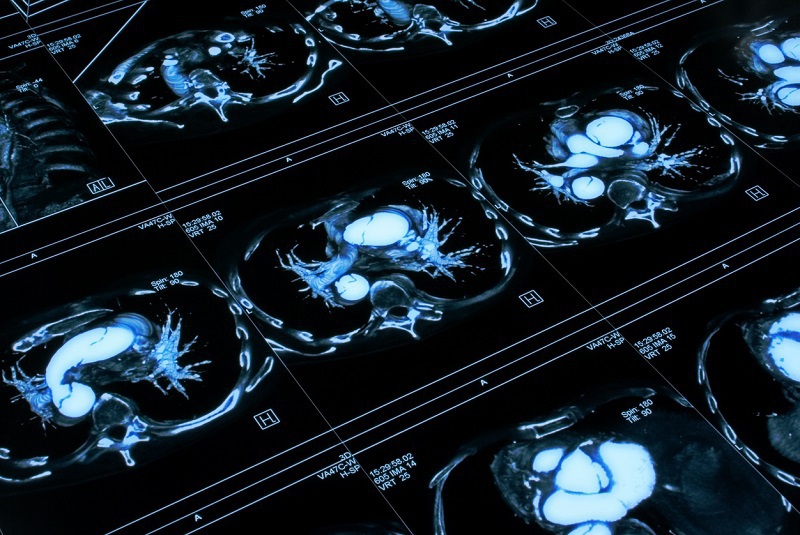 A series of black and white CT scan images showing cross-sectional views of a human chest, highlighting internal organs and anatomical structures.