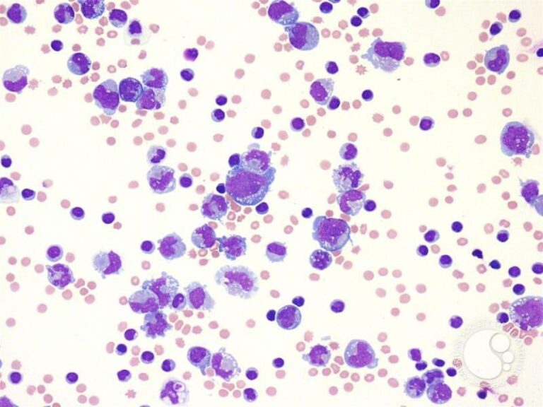 Microscopic image of bone marrow showing numerous purple-stained cells with varying sizes and scattered small pink cells on a white background.
