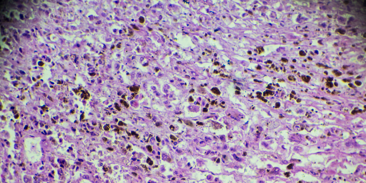 Microscopic view of tissue stained in shades of purple and pink, showing densely packed cells with irregular shapes and dark spots scattered throughout.