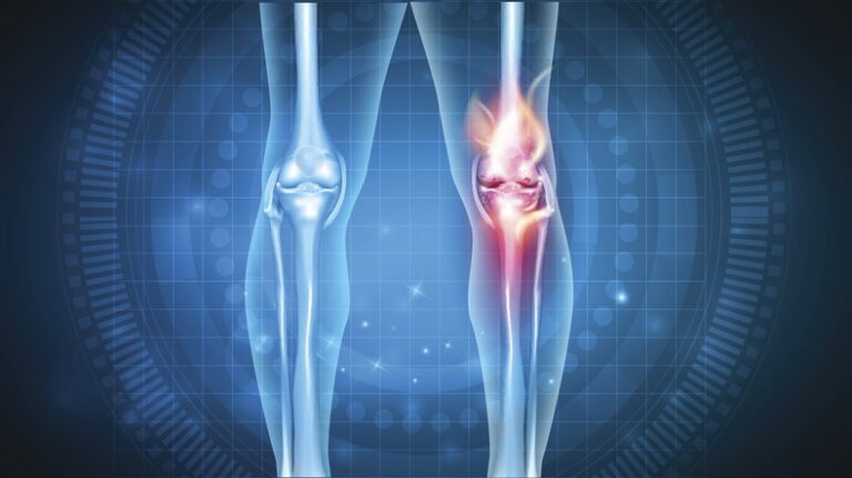 Medical illustration of two knees, one healthy and one with highlighted red pain or inflammation area, indicating joint or knee pain, on a blue digital background.