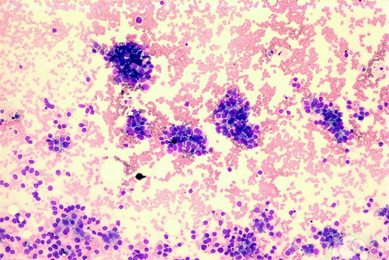 Microscopic image showing clusters of dark purple cells among scattered lighter pink and purple cells, likely indicating abnormal cell growth or a sample of tissue under examination.