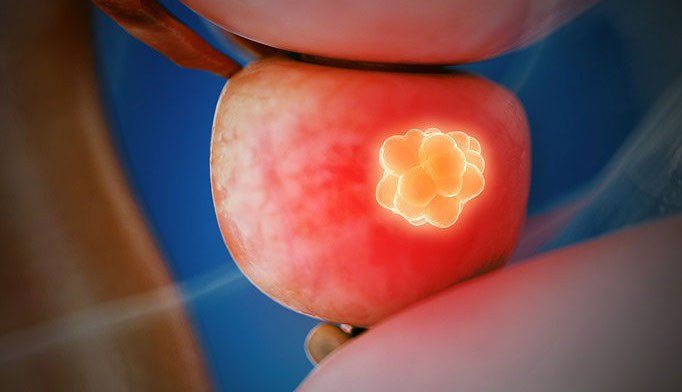 Illustration of a human prostate gland with a highlighted yellowish mass, possibly representing a tumour or abnormal growth, against a blue background.