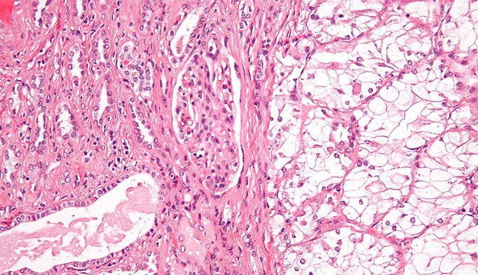 Microscopic view of tissue stained pink and purple, showing densely packed cells on the left and more loosely arranged, clear cells on the right, possibly from a histological specimen.