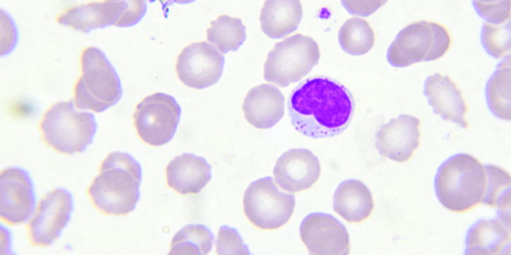 Microscopic view of blood cells, with many light purple cells and one larger, dark purple-stained cell in the centre, indicating a possible abnormality.