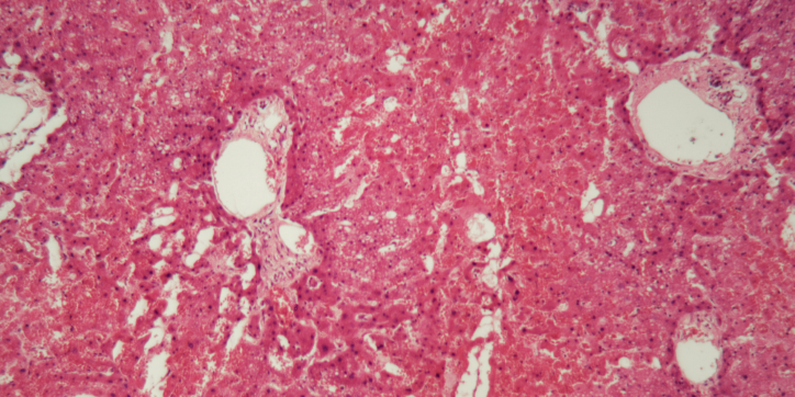 Microscopic view of tissue showing pink and purple staining with several round white empty spaces, indicating possible cells or glands.