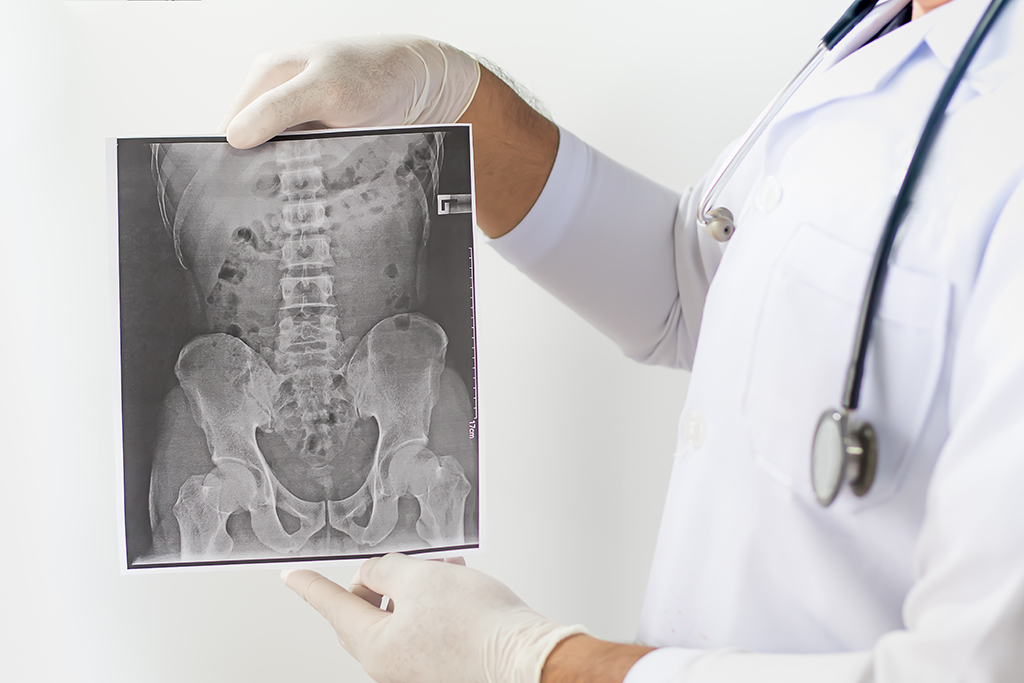A doctor wearing gloves and a white coat holds up an X-ray image of a pelvis and lower spine, with a stethoscope around their neck.