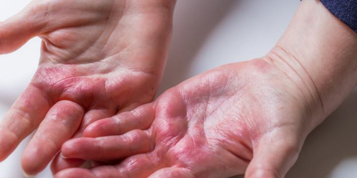 Two open hands with red, irritated, and inflamed skin, possibly showing symptoms of a rash, eczema, or dermatitis.