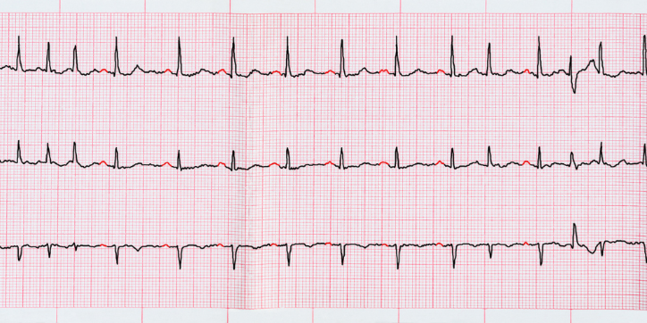 An electrocardiogram (ECG) printout on pink graph paper shows regular peaks and waves, indicating heart rhythms for medical analysis.