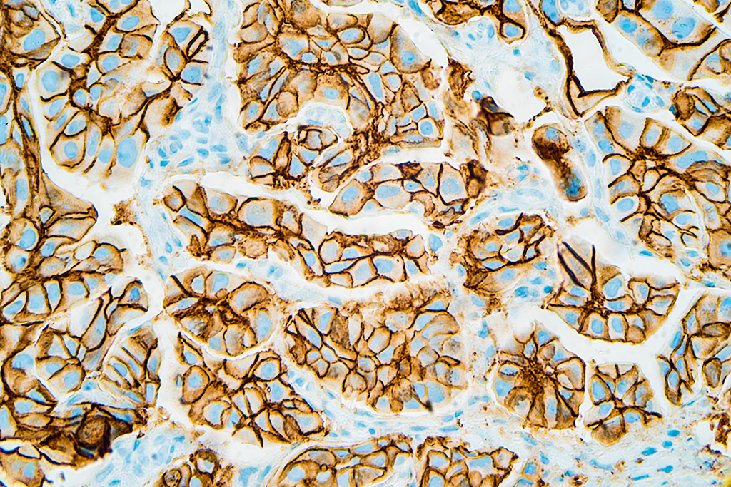 Microscopic close-up of stained tissue showing brown, irregularly shaped cells with dark outlines and blue background, highlighting cellular structure and organisation.