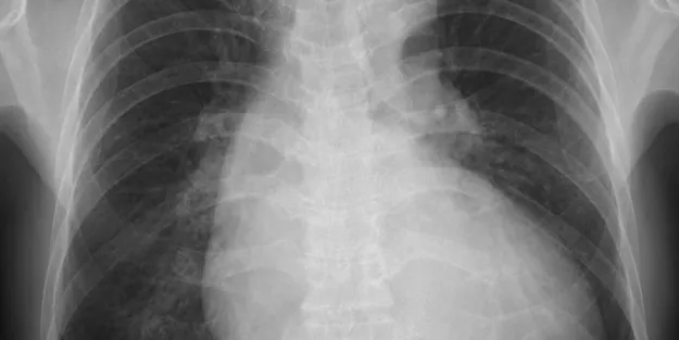 Chest X-ray showing the ribs, spine, and outline of the lungs and heart. The image appears to display areas of both clear and cloudy regions in the lung fields.