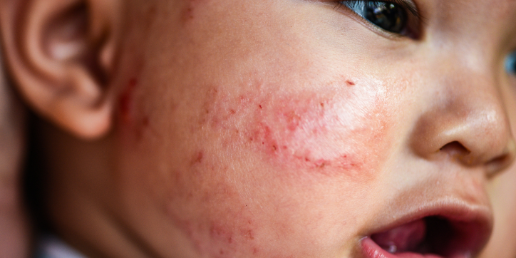 Close-up of a child's face with red, irritated, and scratched skin on the cheek, possibly due to a rash or allergic reaction. The child's mouth is slightly open.