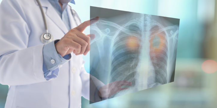 A doctor in a white coat points at a digital X-ray image of a chest, highlighting both lungs.