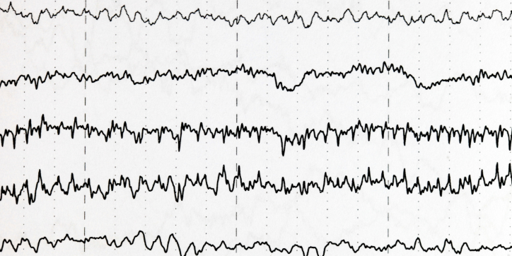 Black wavy lines on white paper show multiple channels of brain wave patterns from an EEG recording, separated by dashed vertical lines.