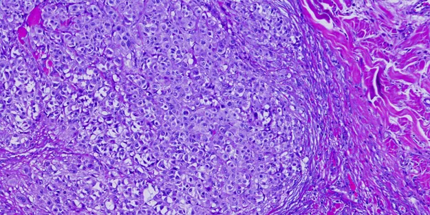 Microscopic view of tissue with densely packed cells in purple and pink hues, showing cellular detail and fibrous structures, likely from a histology slide.