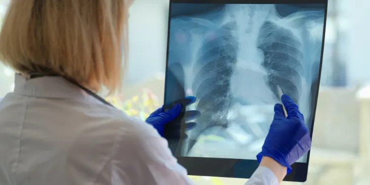 A person wearing blue gloves and a white coat holds up a chest X-ray, examining the image closely.