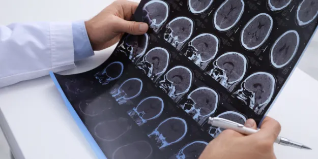A person in a white coat holds and points to a sheet of brain MRI scans with a pen, showing several cross-sectional images of the brain.