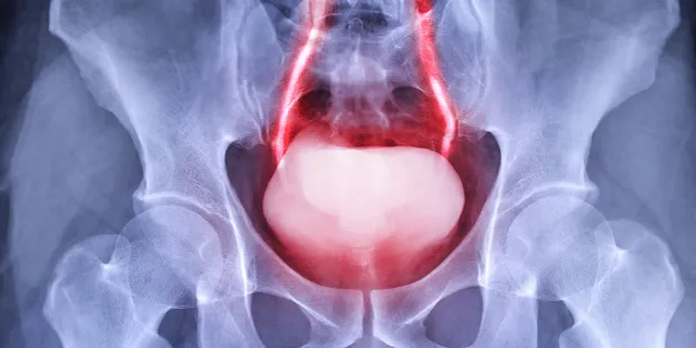 X-ray image showing the pelvis and lower spine, with the bladder and two blood vessels highlighted in red.