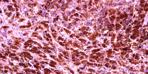 Microscopic image showing densely packed, irregularly shaped cells stained in shades of pink, purple, and red, suggesting a tissue sample, possibly for histological or pathological examination.