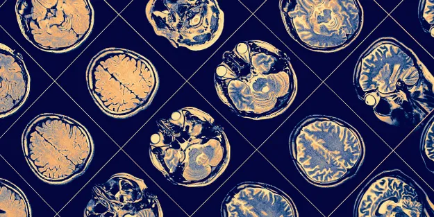 A grid of brain scan images, showing various angles and sections of the human brain in shades of yellow, orange, and blue.