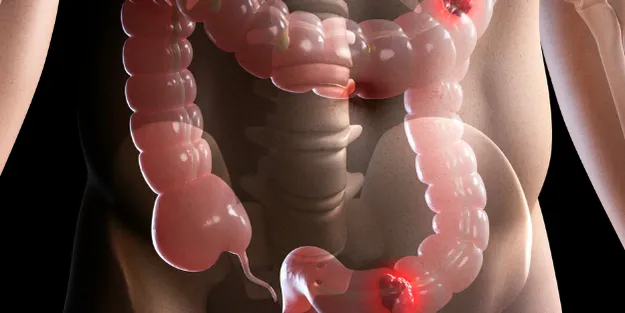 Medical illustration showing a human torso with the colon highlighted and red areas indicating inflammation or possible tumours in multiple locations along the colon.