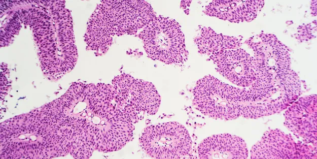 Microscopic image of pink and purple stained tissue, showing clusters of densely packed cells with oval-shaped nuclei, commonly seen in biological or medical histology slides.