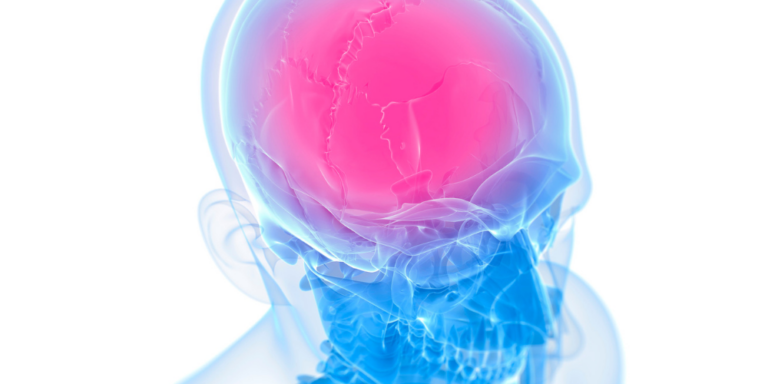 A transparent blue human skull with the top of the brain area highlighted in bright pink, illustrating pain or injury in the upper head region.