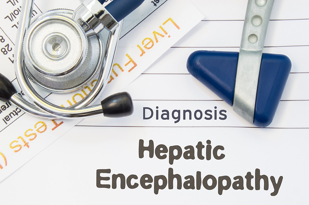 A stethoscope and reflex hammer rest on papers with the words Diagnosis and Hepatic Encephalopathy printed, indicating a medical diagnosis related to liver function.