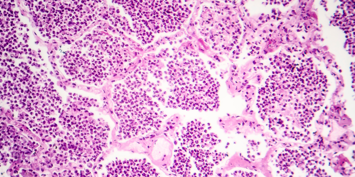 Microscopic image of tissue stained pink and purple, showing clusters of small, round cells with dark nuclei, separated by thin, pale connective tissue. The pattern suggests a densely cellular structure.