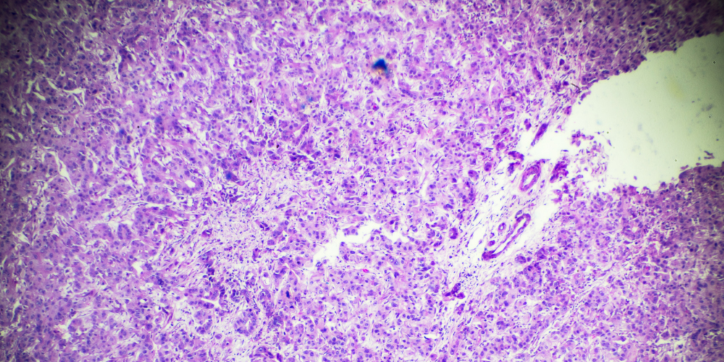 Microscopic view of tissue stained with purple and pink hues, showing densely packed cells and irregular structures, possibly indicative of a biopsy sample for medical analysis.