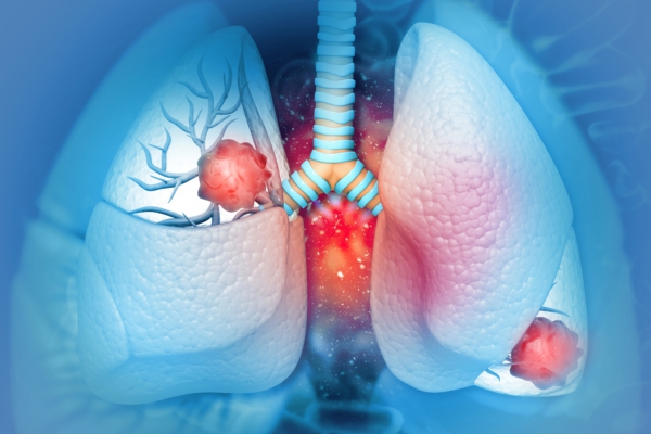 An illustration of human lungs showing tumours in both lungs, with bright red areas highlighting cancer, and blue airways connecting to the trachea against a blue background.