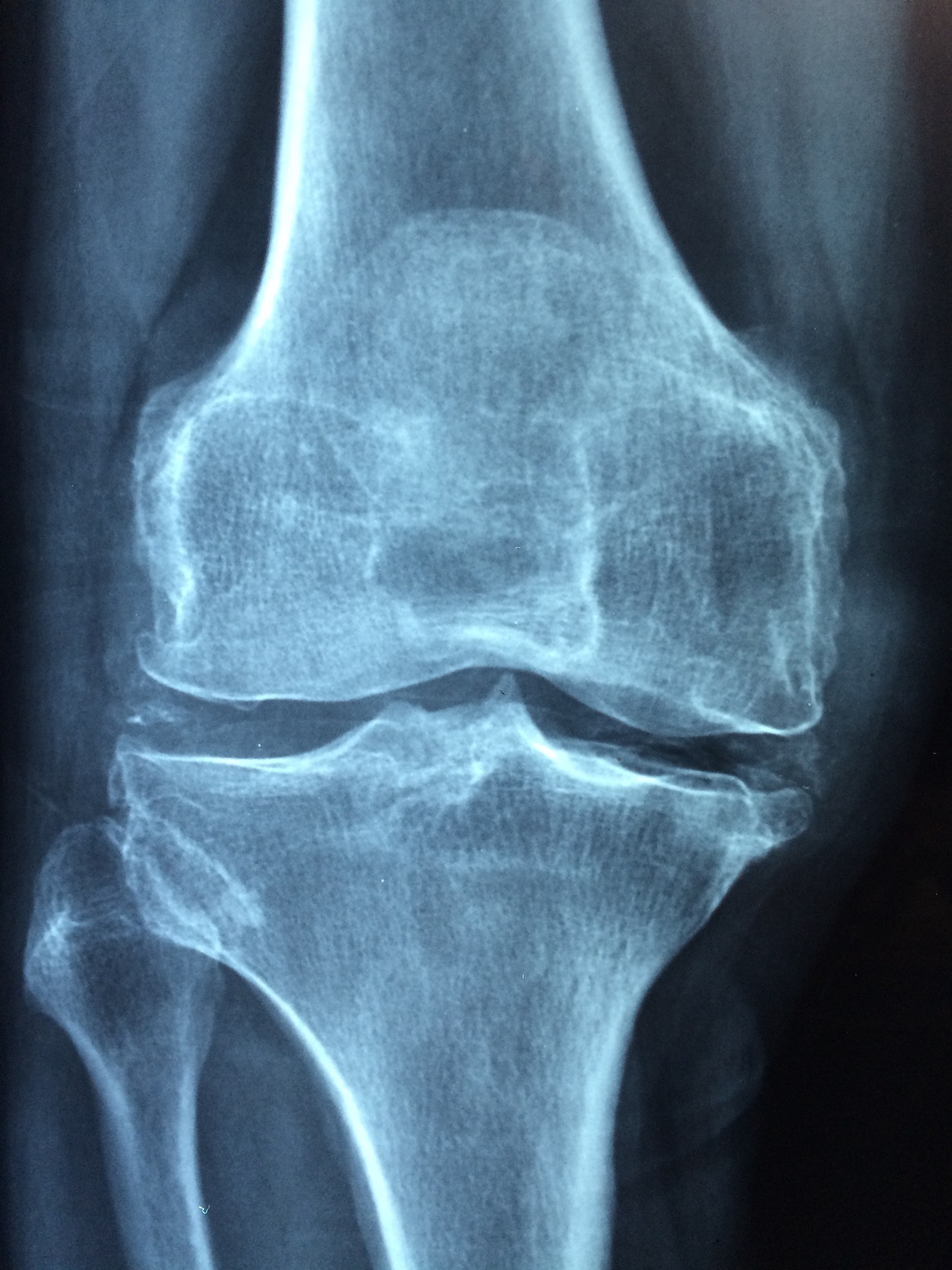 X-ray image showing a frontal view of a human knee joint, including the femur, tibia, and patella, with clear visibility of the bone structure and joint space.