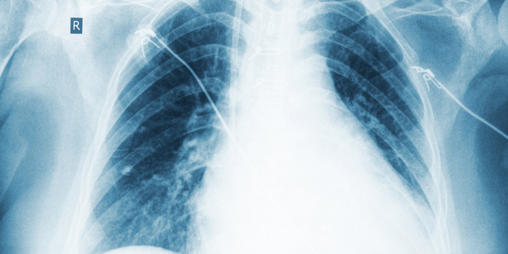 Chest X-ray showing lungs, ribs, and an R marker indicating the right side. Some medical tubes or wires are visible on both sides of the chest.