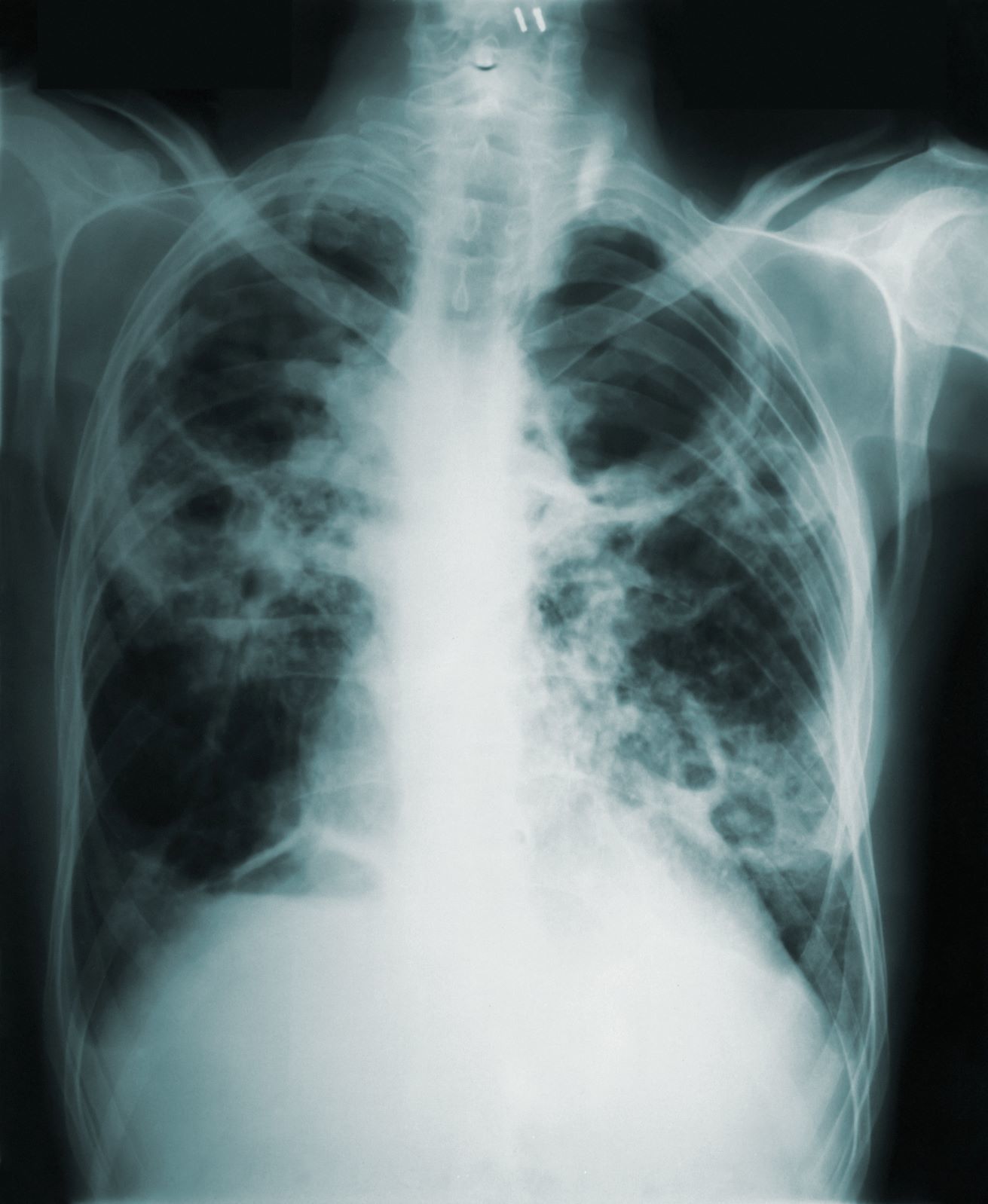 Chest X-ray showing lungs with areas of opacity and possible abnormalities, indicating potential lung disease.