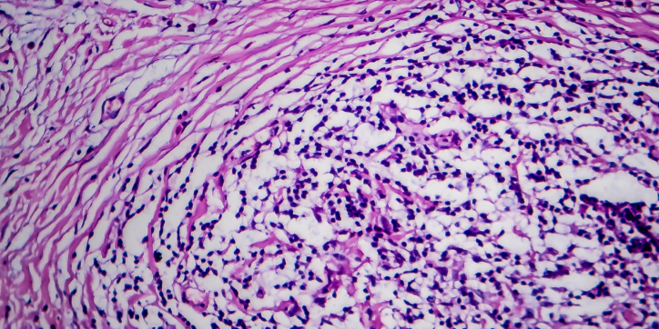 Microscopic view of stained tissue showing dense purple cell clusters and wavy pink fibres, typical of histology slides used to study cellular structures and patterns.