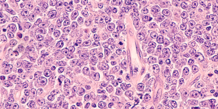 Microscopic view of cells stained pink and purple, showing densely packed, irregularly shaped nuclei, typical of a tissue sample prepared for histological examination.