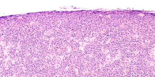 Microscopic image of tissue showing densely packed cells with dark nuclei and some pink cytoplasm, likely representing a histology slide stained with haematoxylin and eosin (H&E).