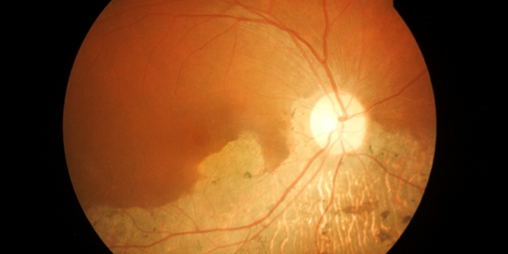 Close-up image of a human retina showing blood vessels radiating from the optic disc, with an irregular, pale area suggesting possible retinal disease or abnormality.