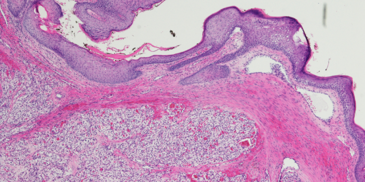 Microscopic image of tissue stained with pink and purple dye, showing layers of cells with dense clusters and some empty spaces, commonly seen in histology slides for medical examination.