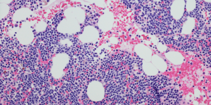 Microscopic view of bone marrow showing clusters of purple-stained blood cells, pink-stained areas, and large white adipocyte cells dispersed throughout the tissue.
