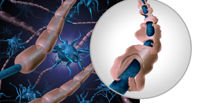 Illustration of nerve cells with damaged myelin sheaths, highlighting demyelination in a magnified section, representing a neurological condition such as multiple sclerosis.