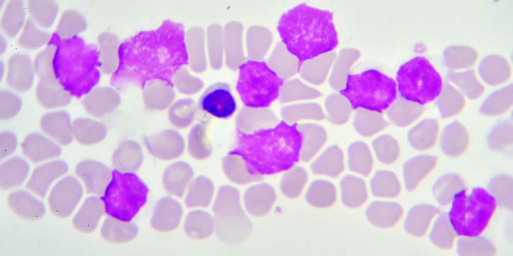 Microscopic view of blood cells, showing many large, irregular purple cells among smaller, pale pink cells, typical of leukaemia under a microscope.