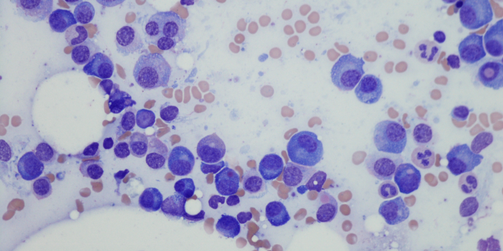 Microscopic image of bone marrow cells showing a mix of large, dark purple cells and smaller, light pink cells scattered throughout a pale background.