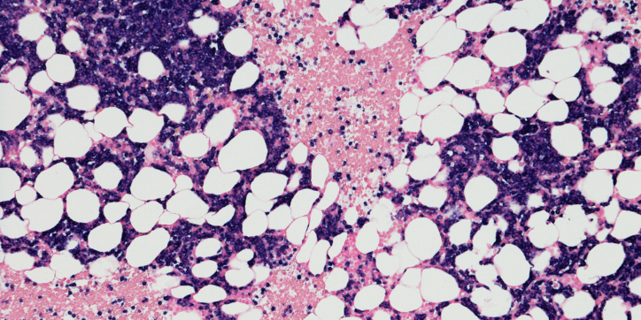 Microscopic image of bone marrow showing clusters of purple cells and large white fat droplets scattered throughout a pink matrix.