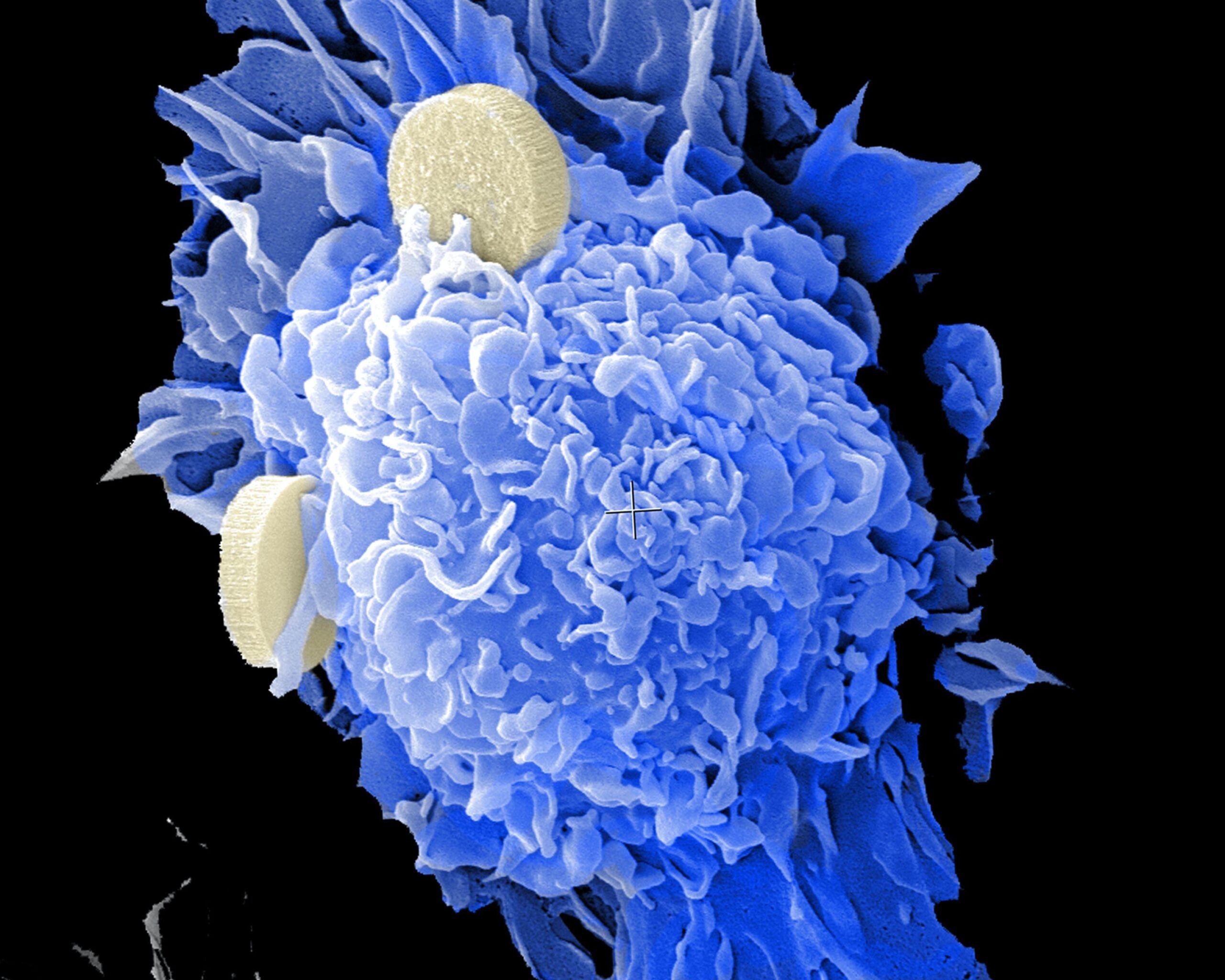 A colourised electron microscope image showing a blue, textured cancer cell surrounded by two pale yellow, disc-shaped red blood cells on a black background.